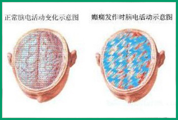 脑电图